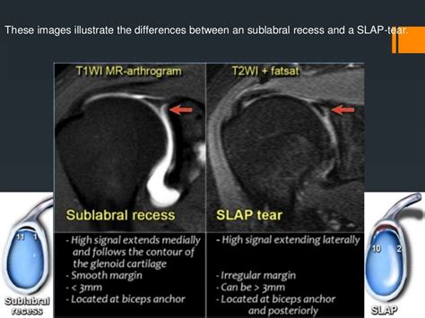 best imaging for labral tear